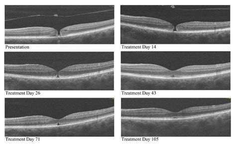 macular thickness treatment